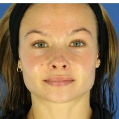 Acne & Scars — after