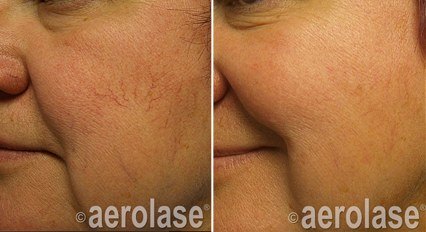 Acne & Scars — before and after