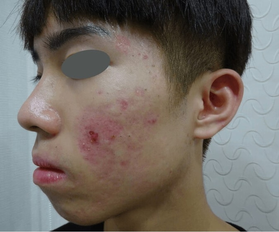 אקנה פעיל — before