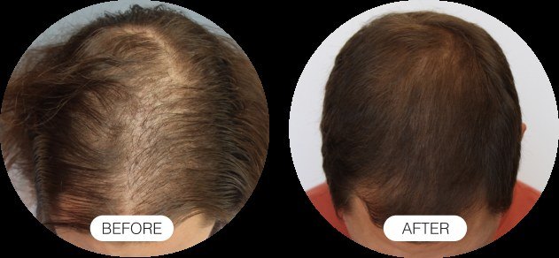 Hair Growth — before and after