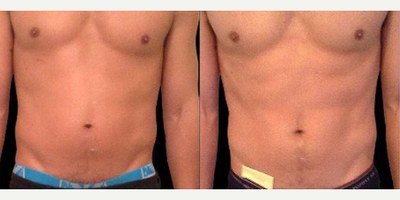 עיצוב גוף — before and after