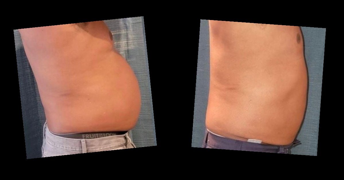 Body Contouring — before and after