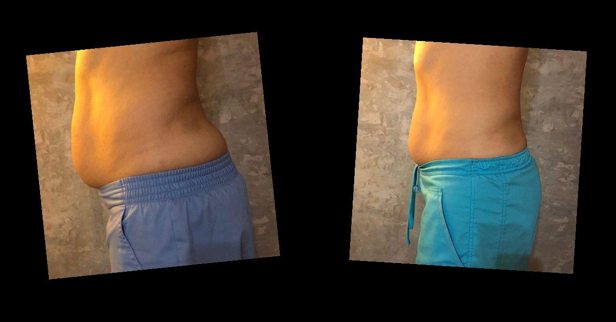Body Contouring — before and after