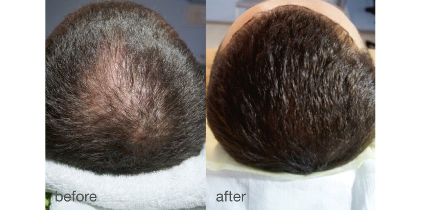Hair Growth — before and after