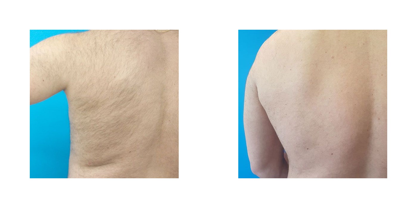 הסרת שיער — מותן ובית שחי — before and after