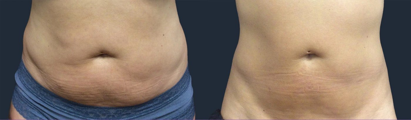 עיצוב גוף — before and after