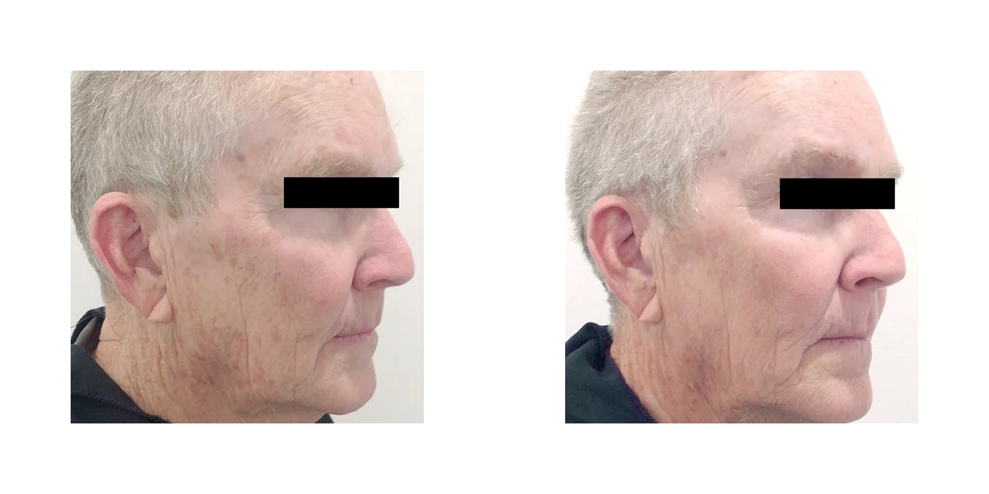 TriBella — נגעים פיגמנטריים ומרקם — before and after