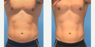 חיטוב שרירים — before and after