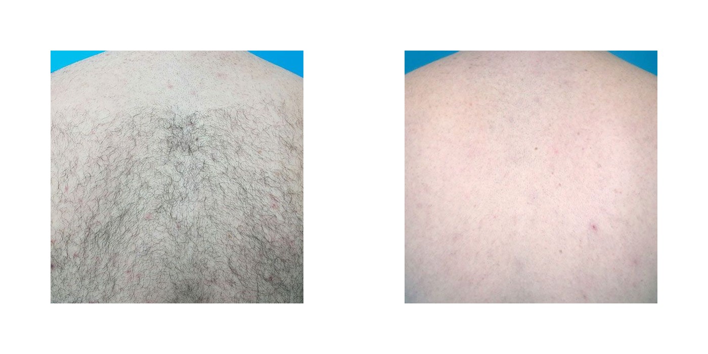 הסרת שיער — גב — before and after