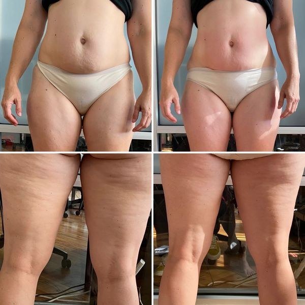 מיצוק עור — before and after