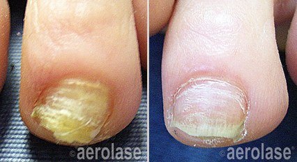 Nail Fungus — before and after