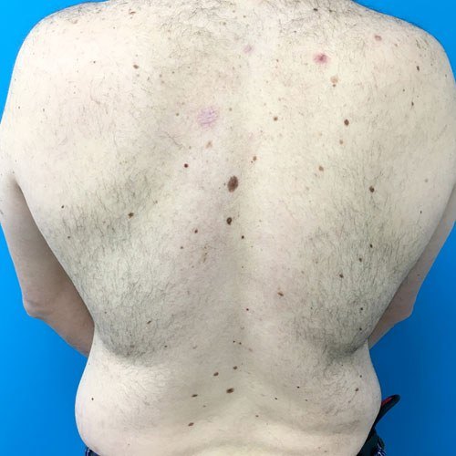הסרת שיער — before