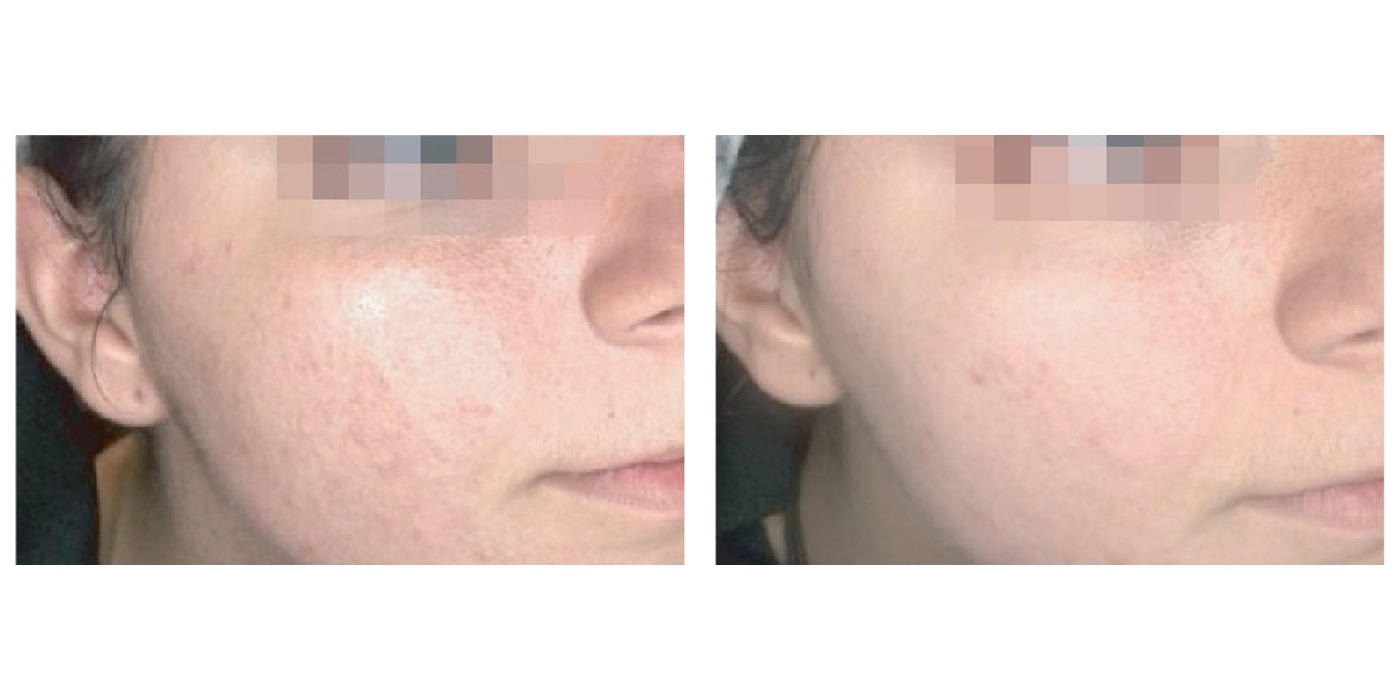 אקנה פעיל — before and after