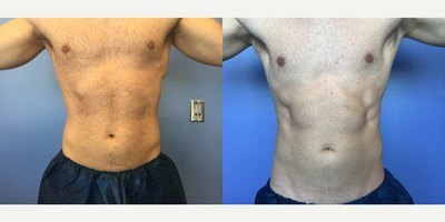 חיטוב שרירים — before and after