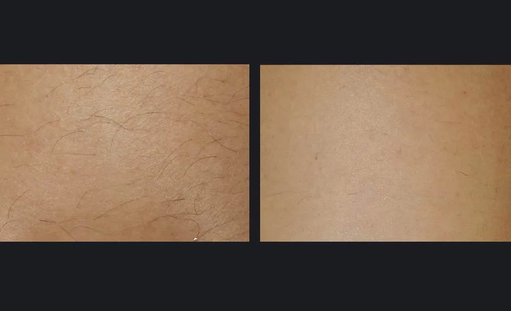 הסרת שיער — before and after