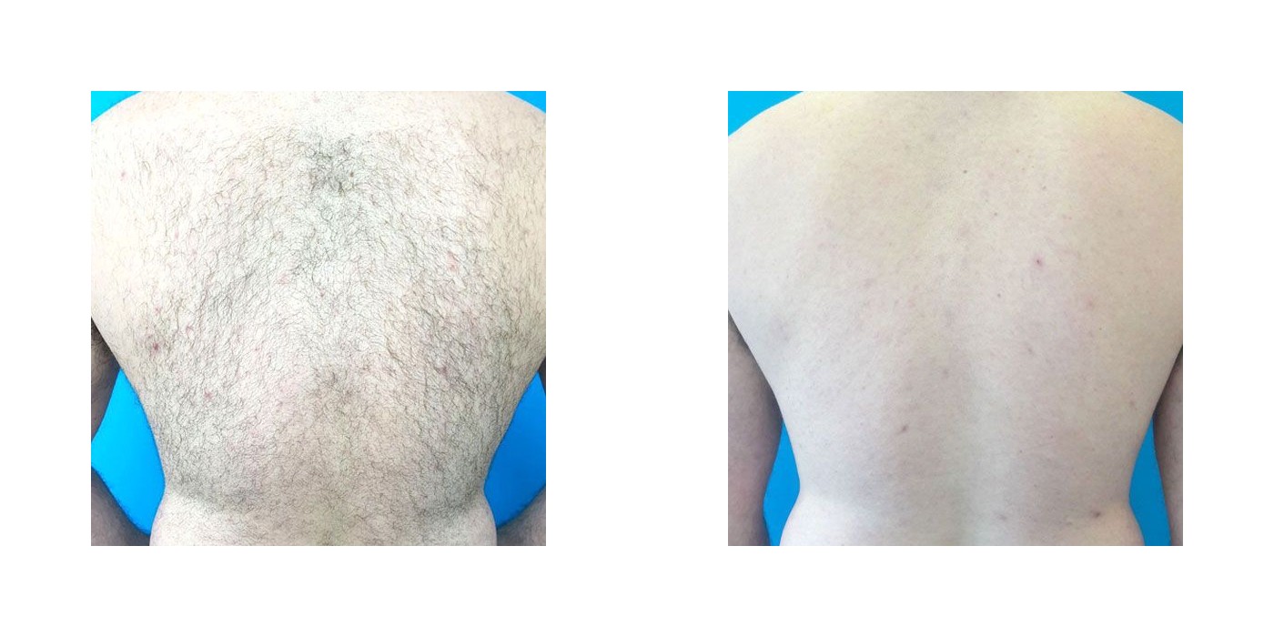 הסרת שיער — גב עליון וכתפיים — before and after