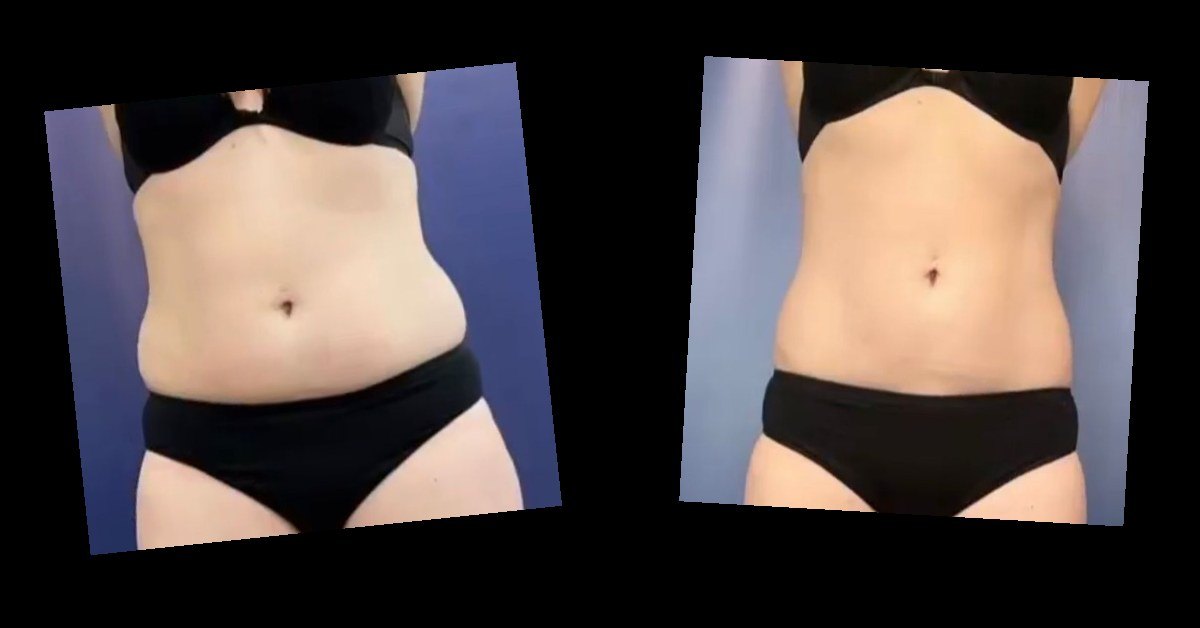 Body Contouring — before and after