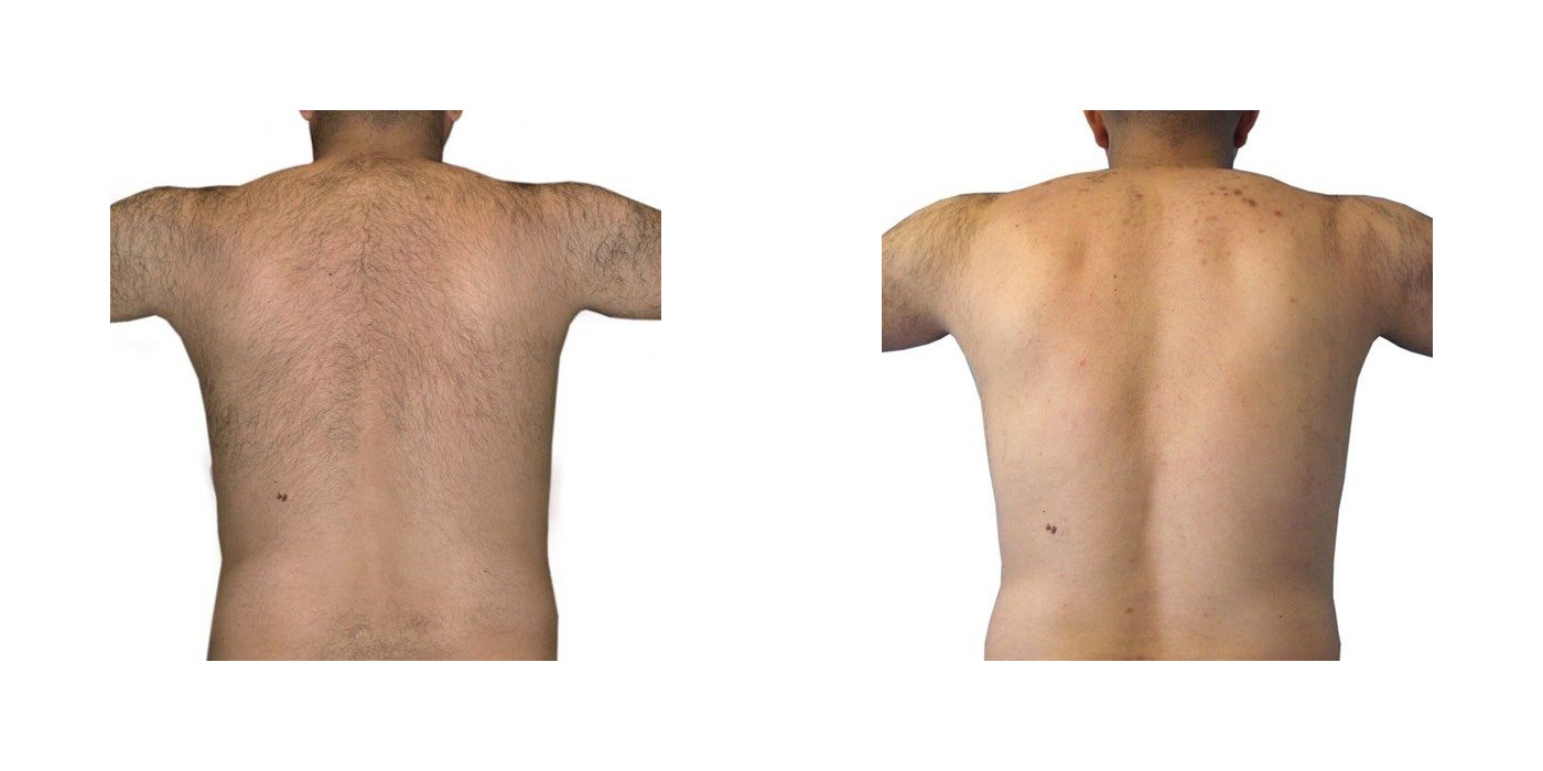 הסרת שיער — גב (גברים) — before and after