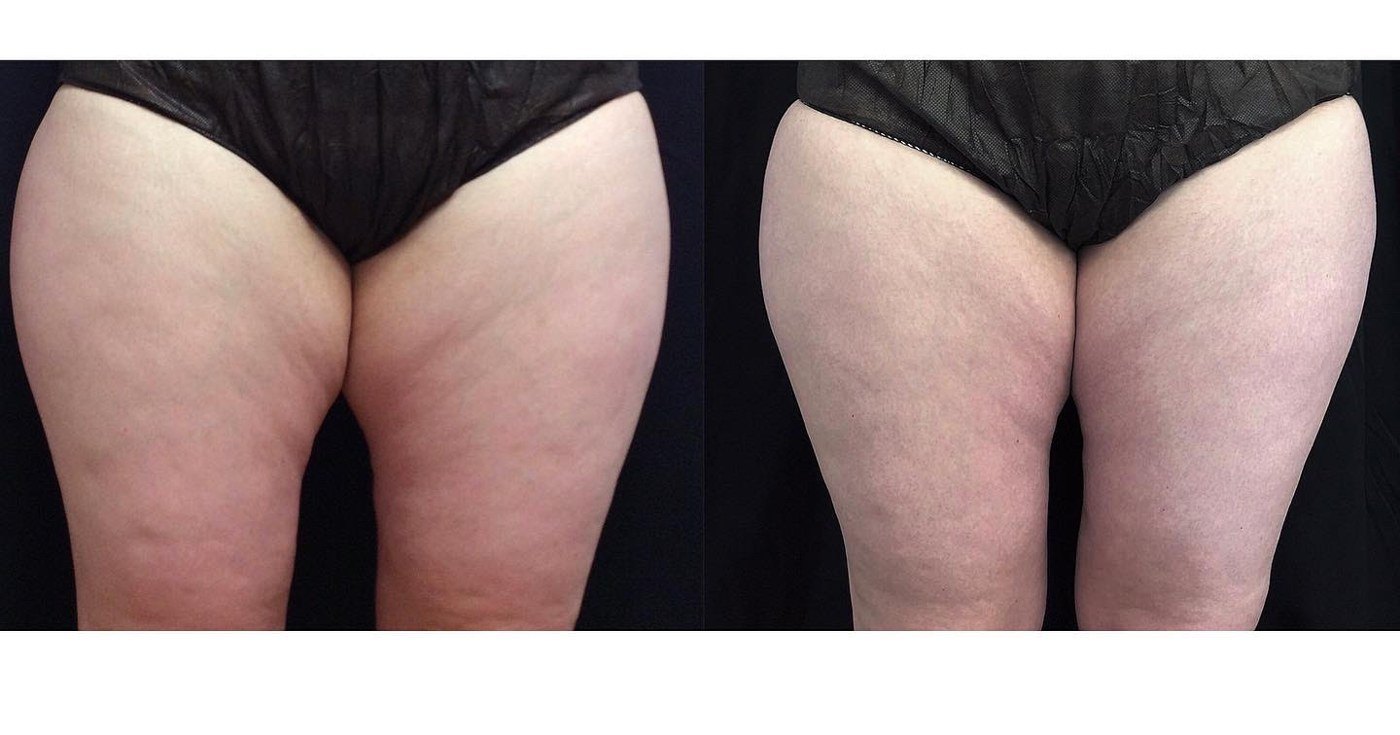 עיצוב גוף — before and after