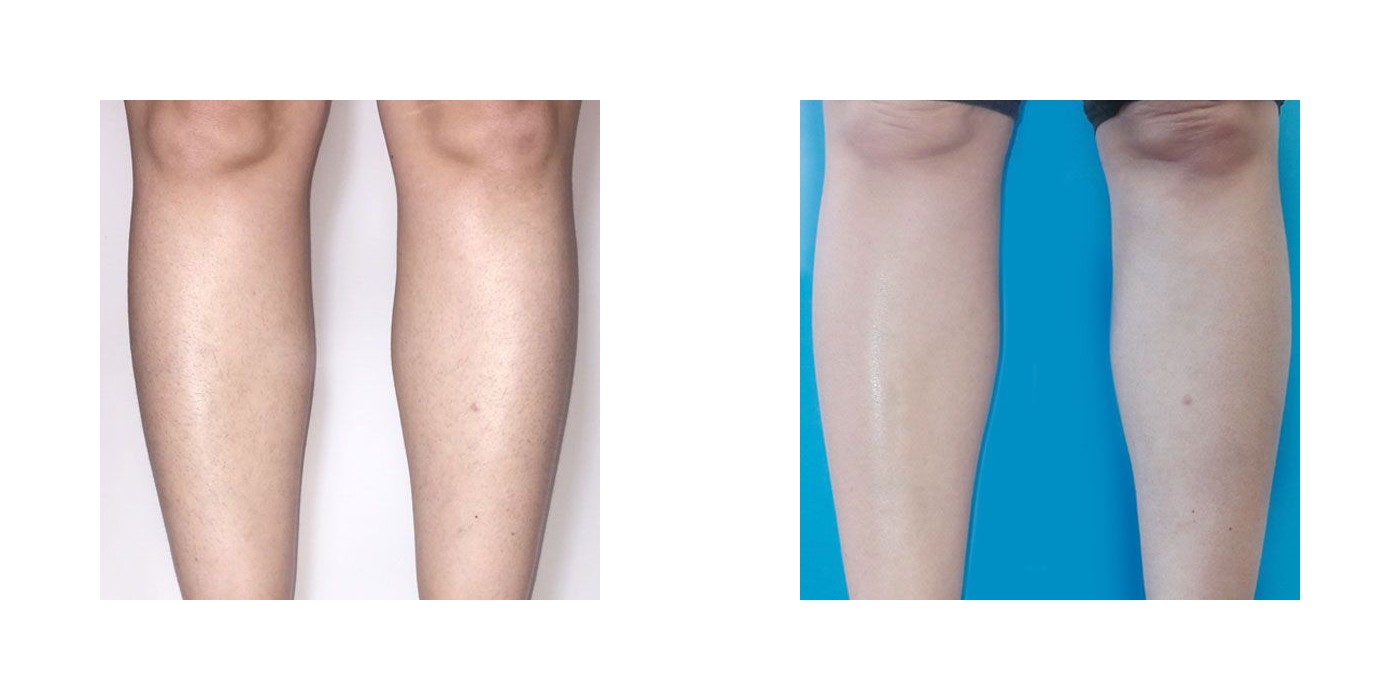 הסרת שיער — רגליים — before and after