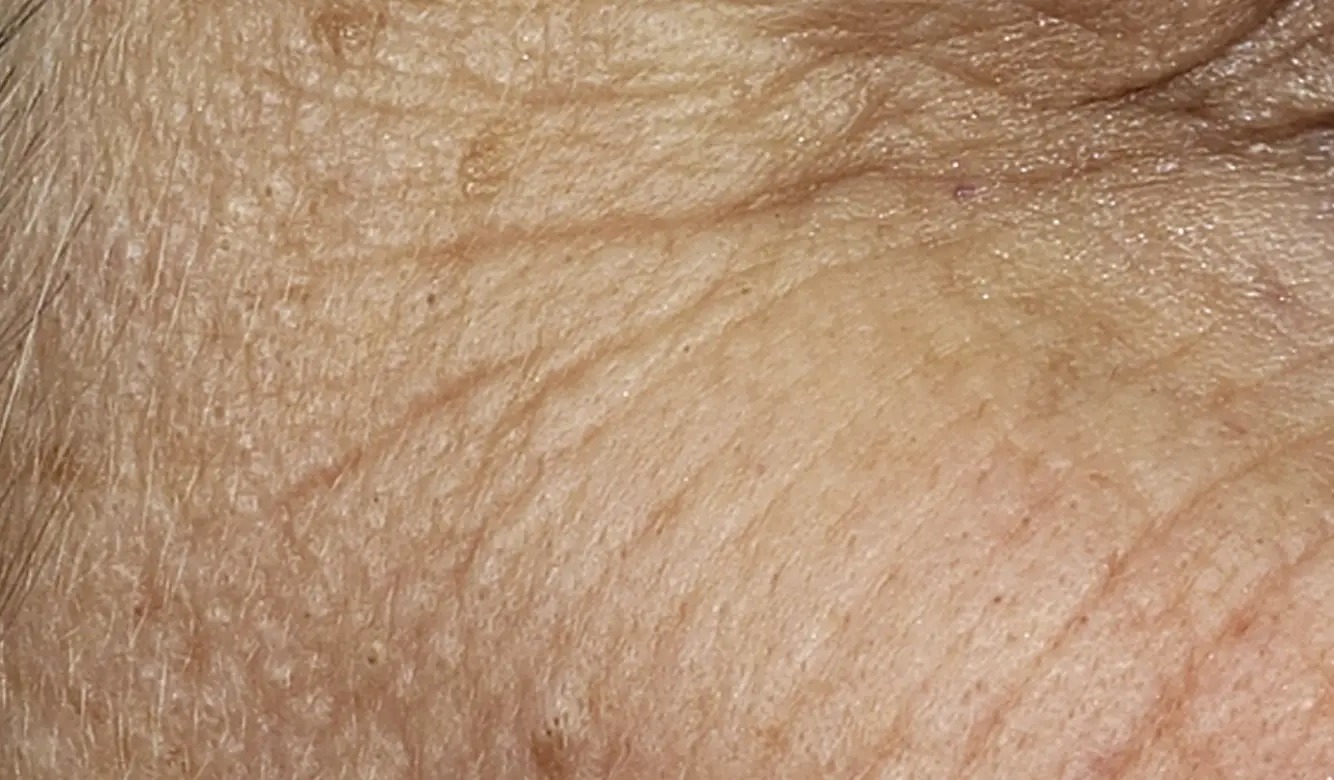 צלקות אקנה וצלקות ניתוח — before