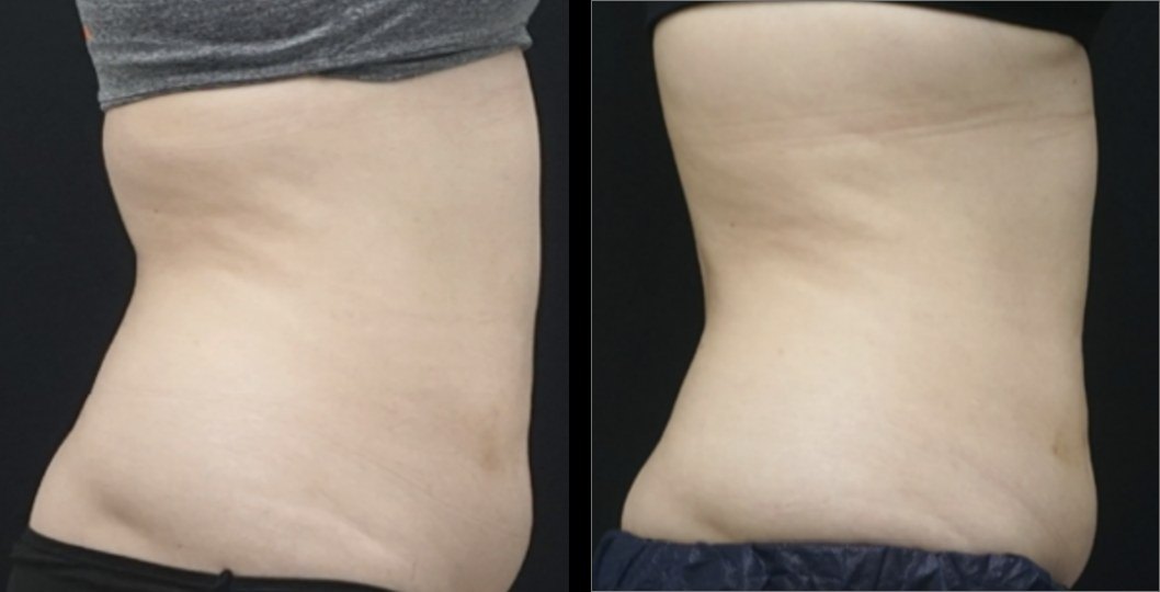עיצוב גוף — before and after