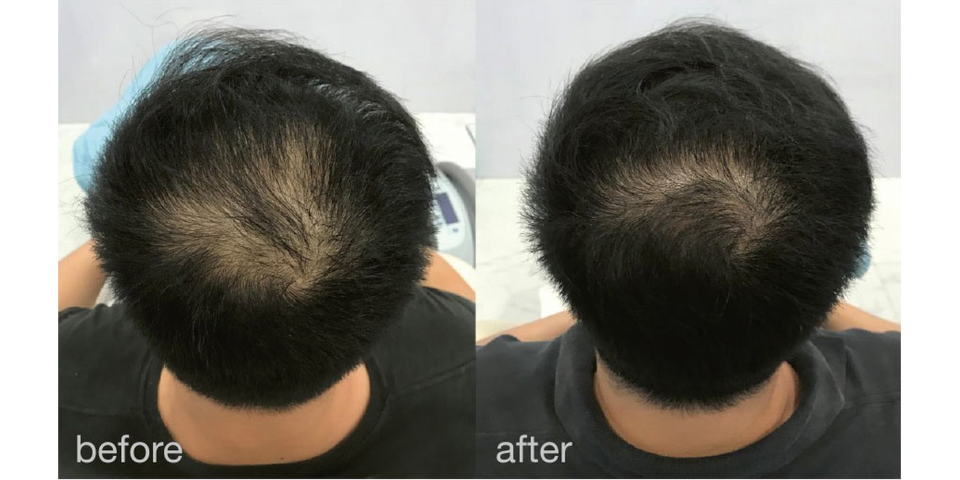 Hair Growth — before and after