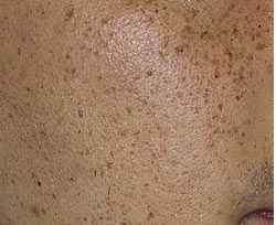 כתמי פיגמנטציה — before
