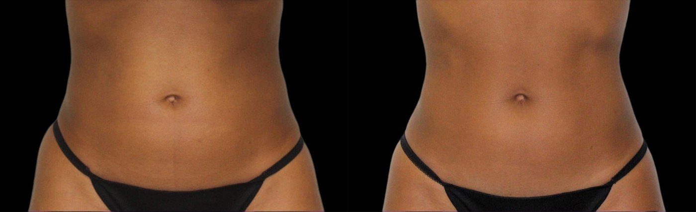 עיצוב גוף — before and after