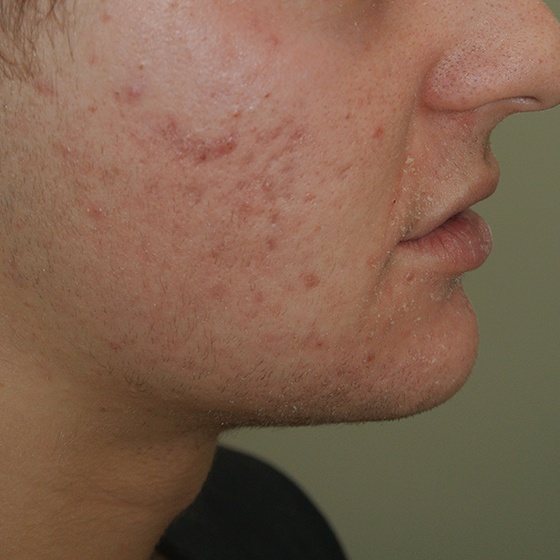 אקנה וצלקות — before