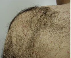 הפחתת שיער בכתפיים — before