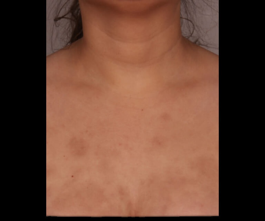 נגעים פיגמנטריים — before