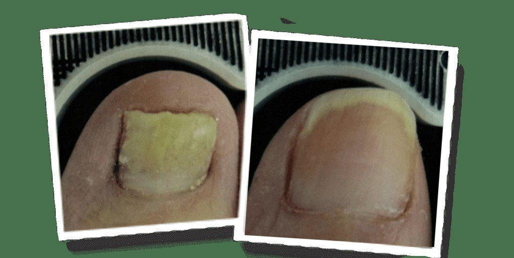 Nail Fungus — before and after