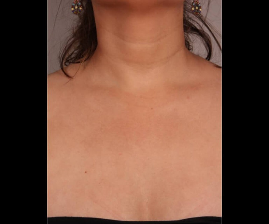 נגעים פיגמנטריים — after