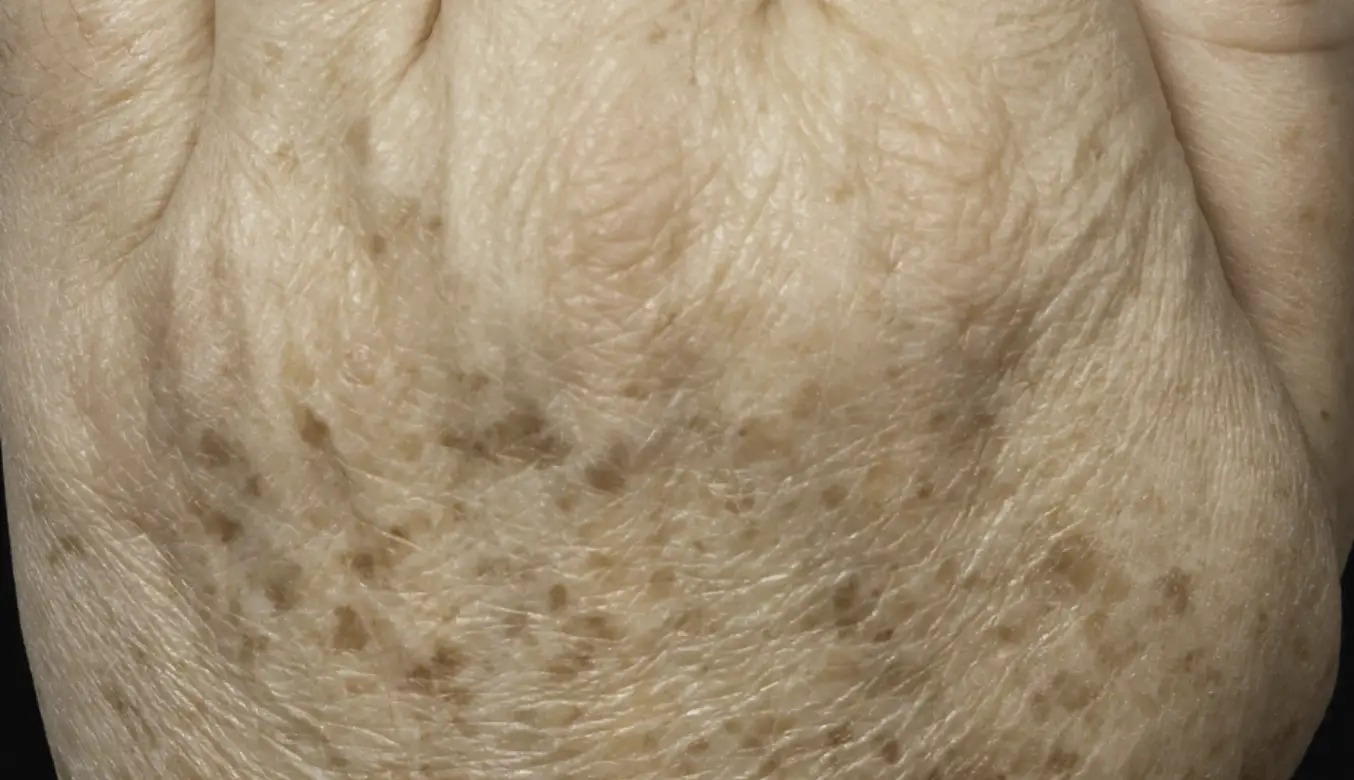 קרטוזיס אקטינית — before