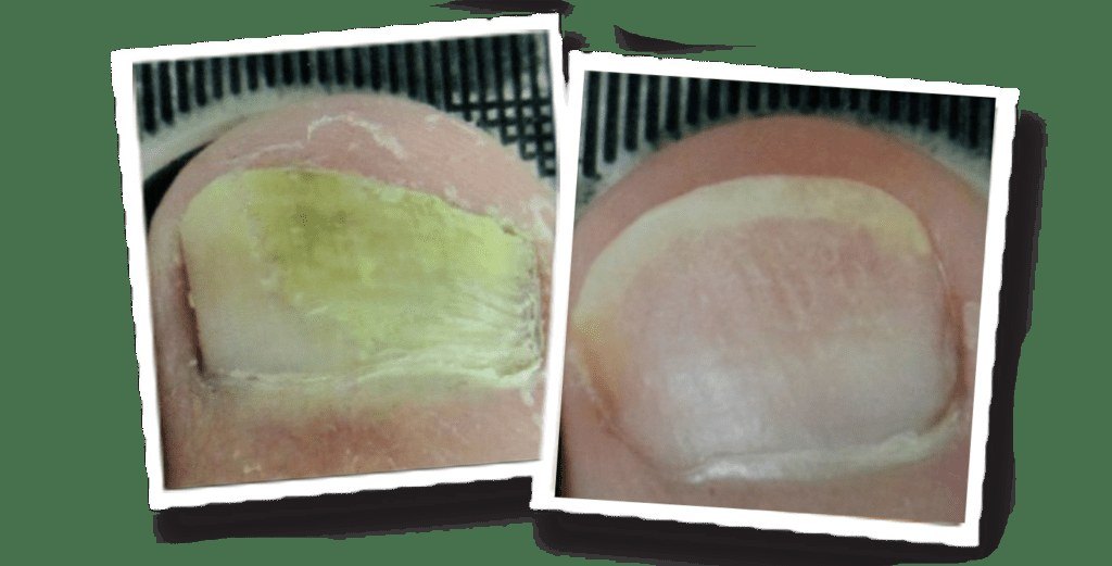 Nail Fungus — before and after