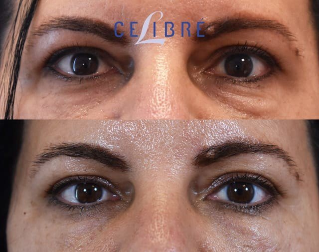 חידוש עור — before and after