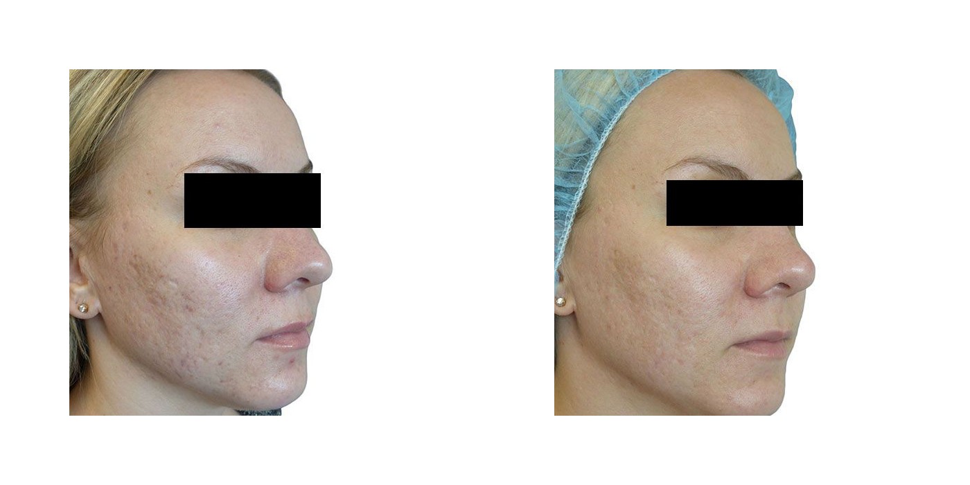 חידוש עור (NanoFractional RF) — before and after