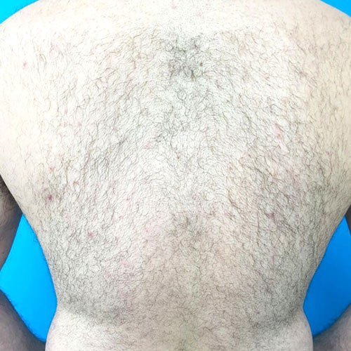 הסרת שיער — before