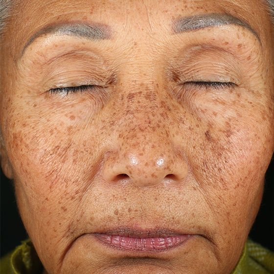 פיגמנטציה — before