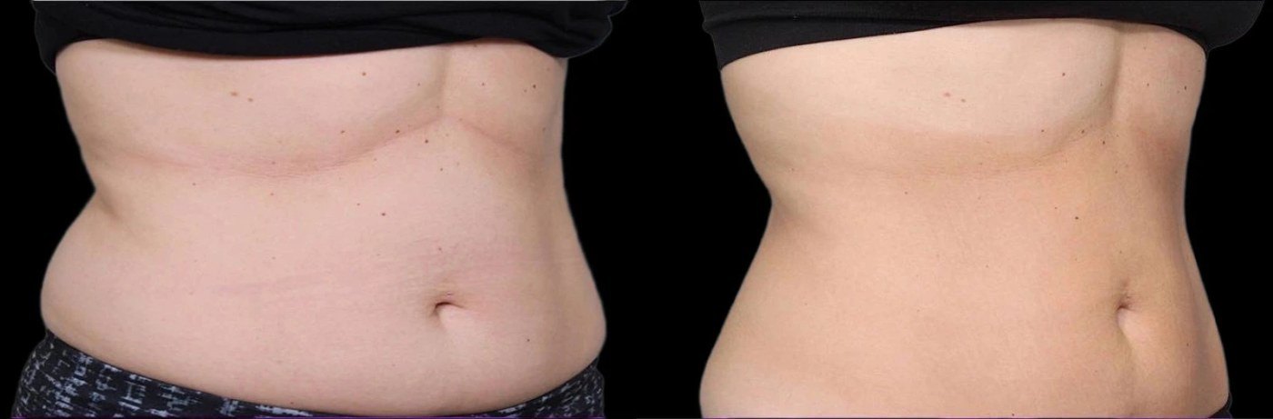 עיצוב גוף — before and after