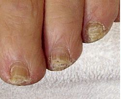 פטרת ציפורניים — before