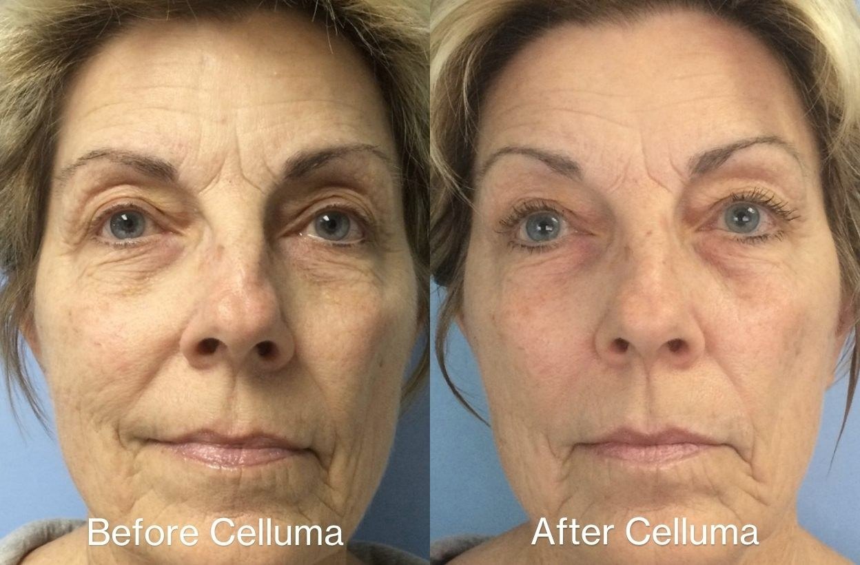 חידוש עור — before and after