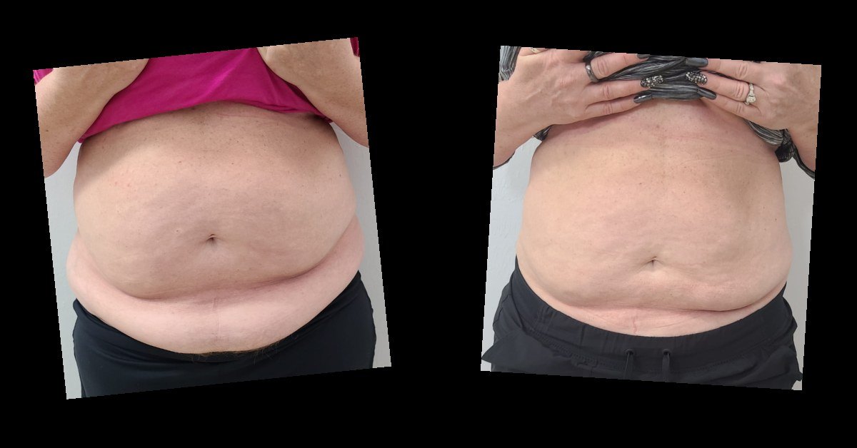 Body Contouring — before and after
