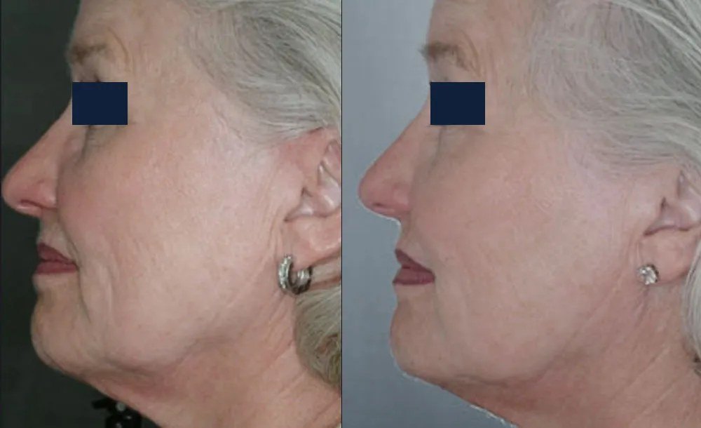פיגמנטציה — before and after