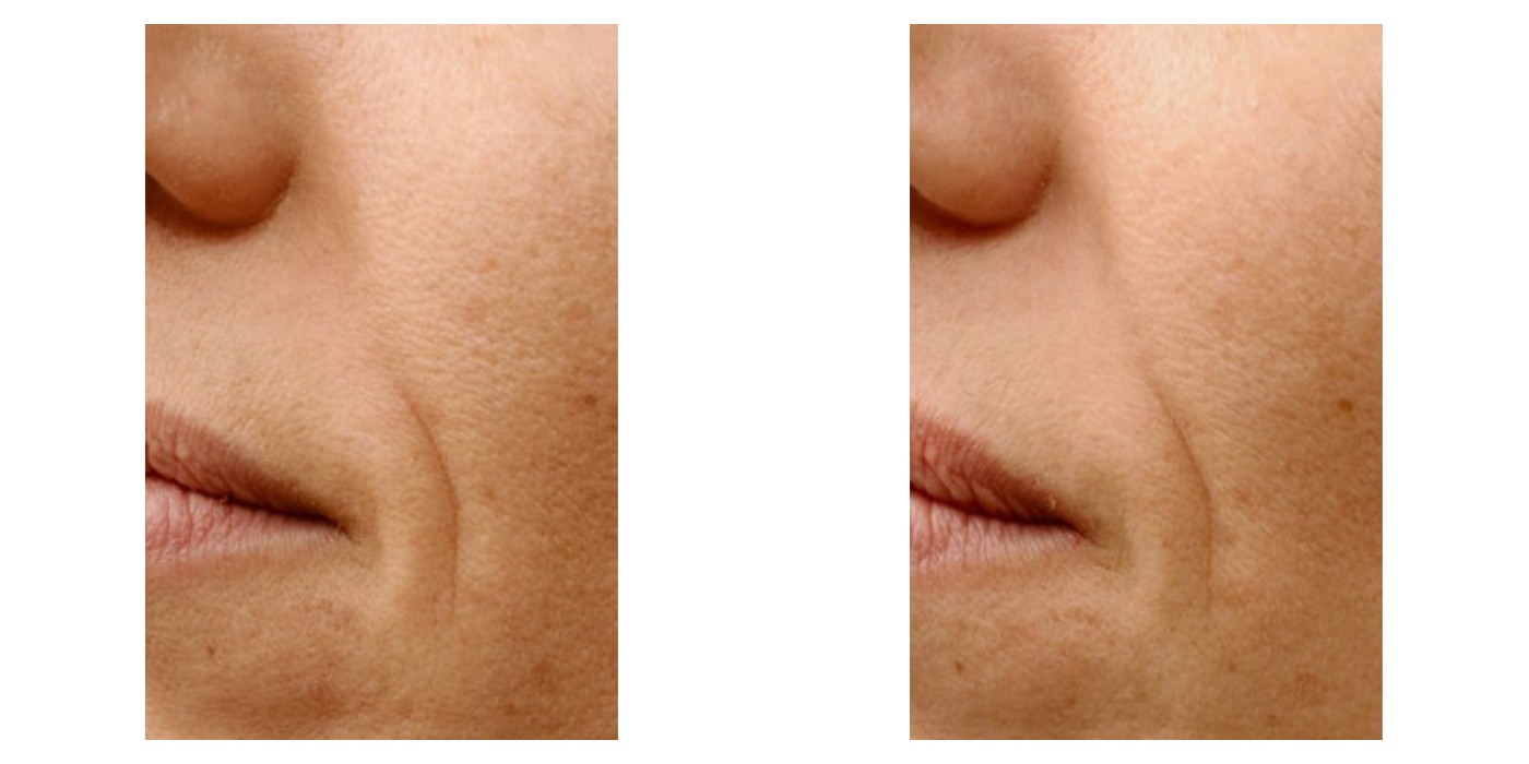 שיפור מרקם העור וקווים דקים סביב הפה — before and after