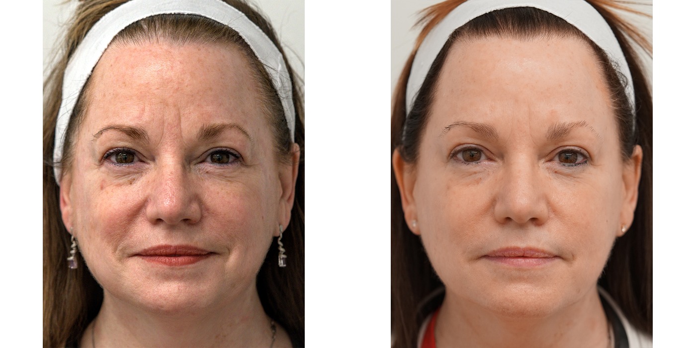 BBL HEROic — אדמומיות ונזקי שמש בפנים — before and after
