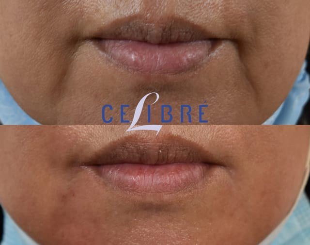 חידוש עור — before and after