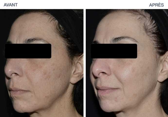 Skin Resurfacing — before and after