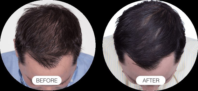 Hair Growth — before and after
